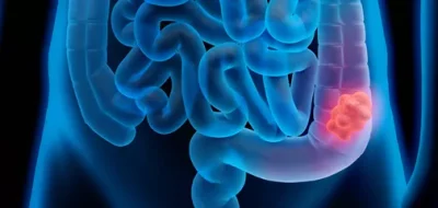 Enfermedad Diverticular/Diverticulitis