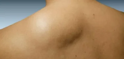 Tumores Benignos/Lipomas