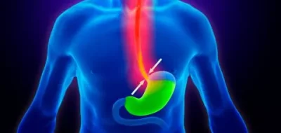 Enfermedad por reflujo gastroesofágico