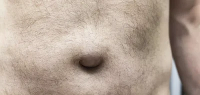 Hernia Umbilical