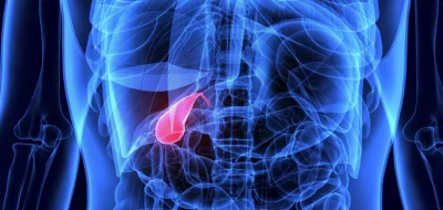 Cálculos (piedras)/Inflamación en la Vesícula